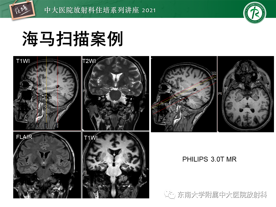 影像PPT - 【PPT】癫痫MR成像与常见疾病-25