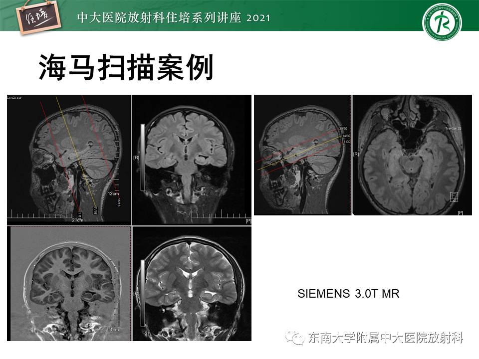 影像PPT - 【PPT】癫痫MR成像与常见疾病-26
