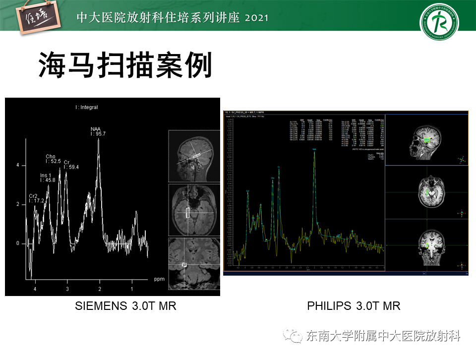 影像PPT - 【PPT】癫痫MR成像与常见疾病-27