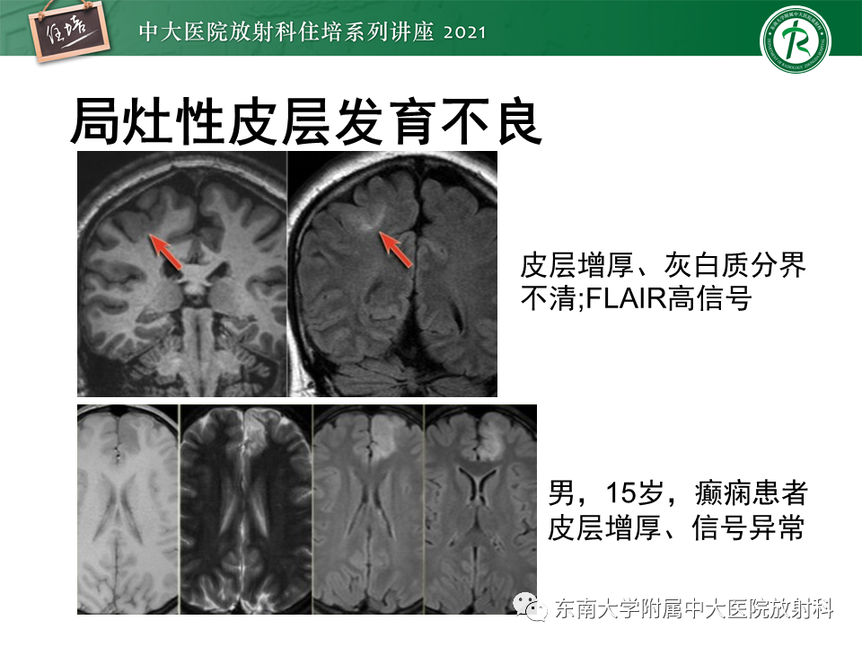 影像PPT - 【PPT】癫痫MR成像与常见疾病-30