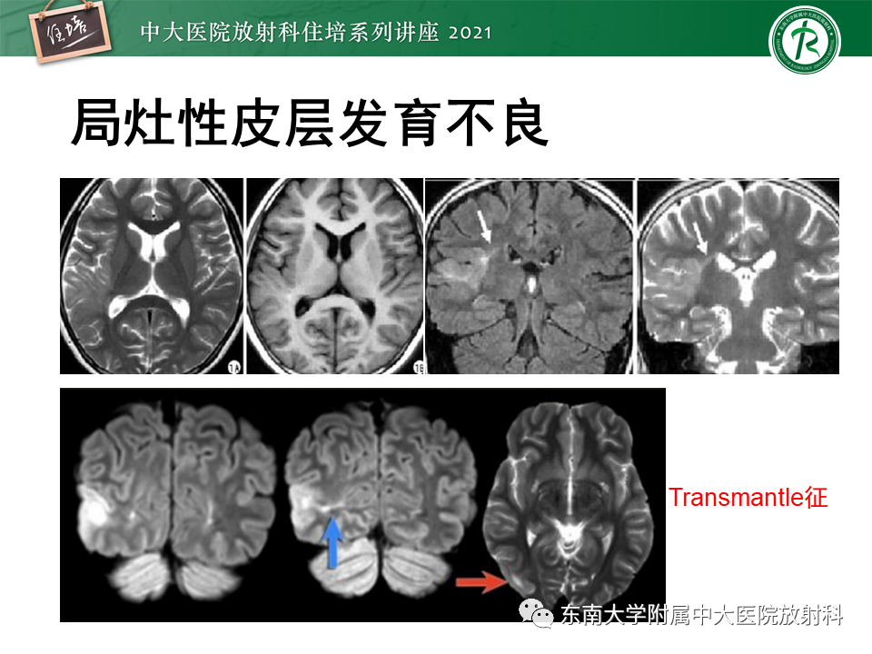 影像PPT - 【PPT】癫痫MR成像与常见疾病-31