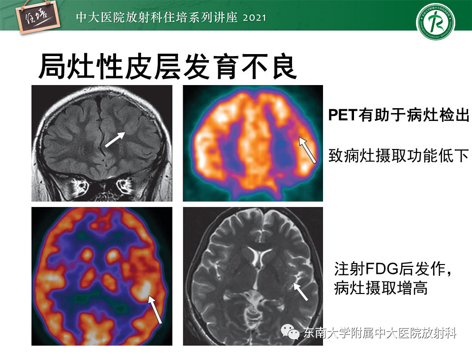 影像PPT - 【PPT】癫痫MR成像与常见疾病-32