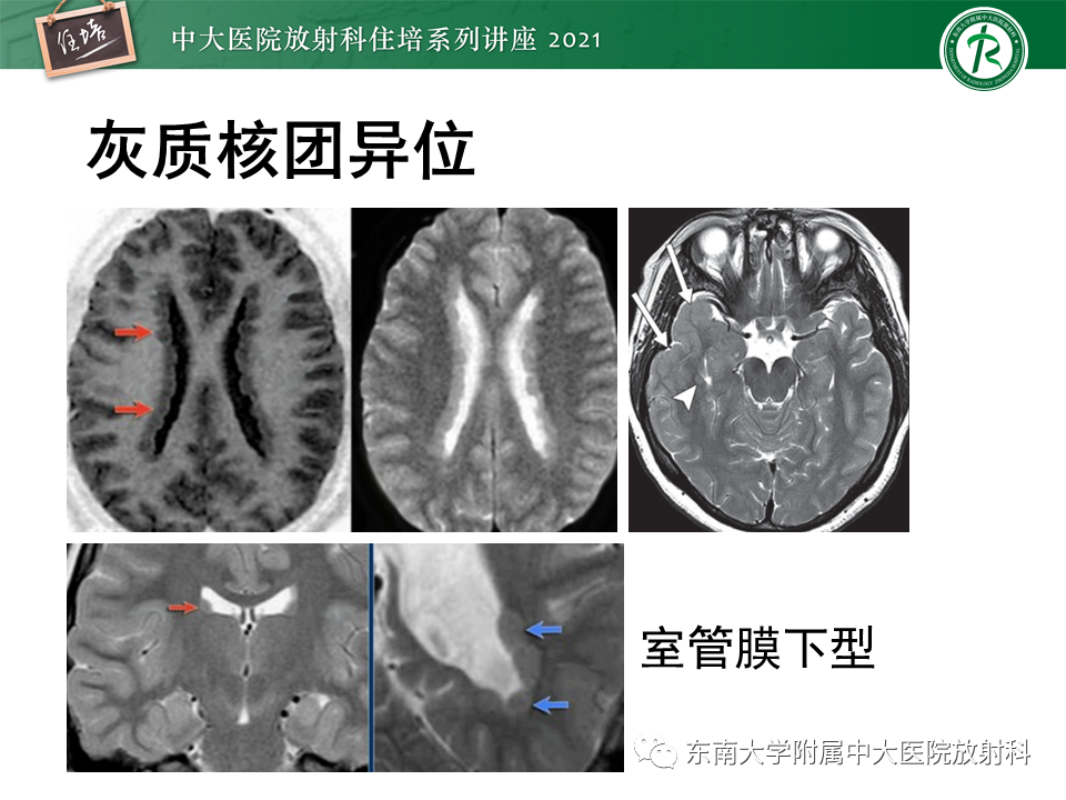 影像PPT - 【PPT】癫痫MR成像与常见疾病-34