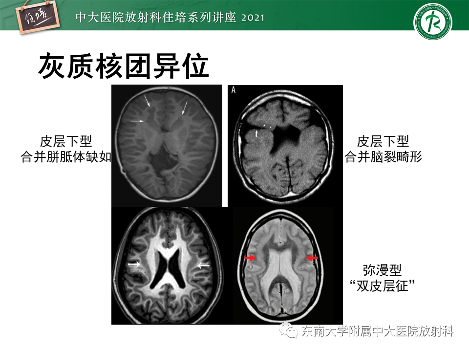 影像PPT - 【PPT】癫痫MR成像与常见疾病-35