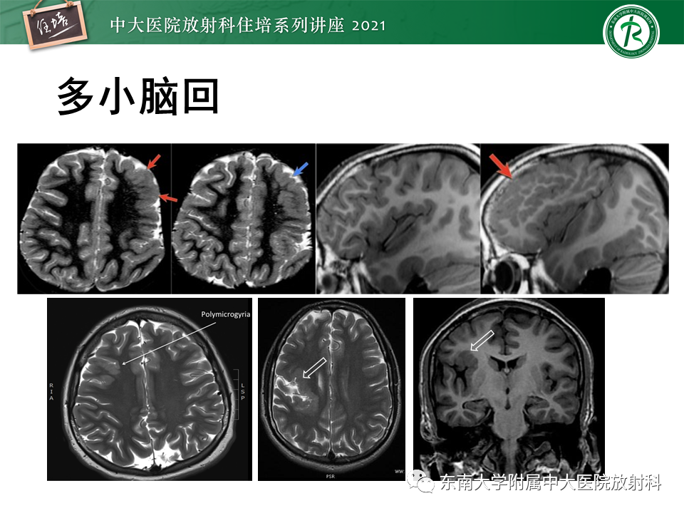 影像PPT - 【PPT】癫痫MR成像与常见疾病-37