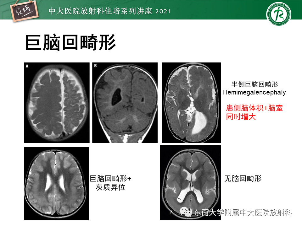 影像PPT - 【PPT】癫痫MR成像与常见疾病-39