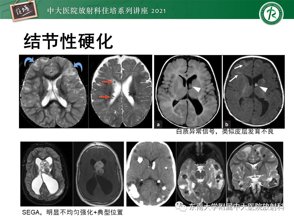 影像PPT - 【PPT】癫痫MR成像与常见疾病-42