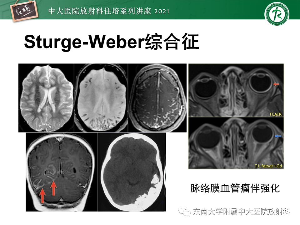 影像PPT - 【PPT】癫痫MR成像与常见疾病-45