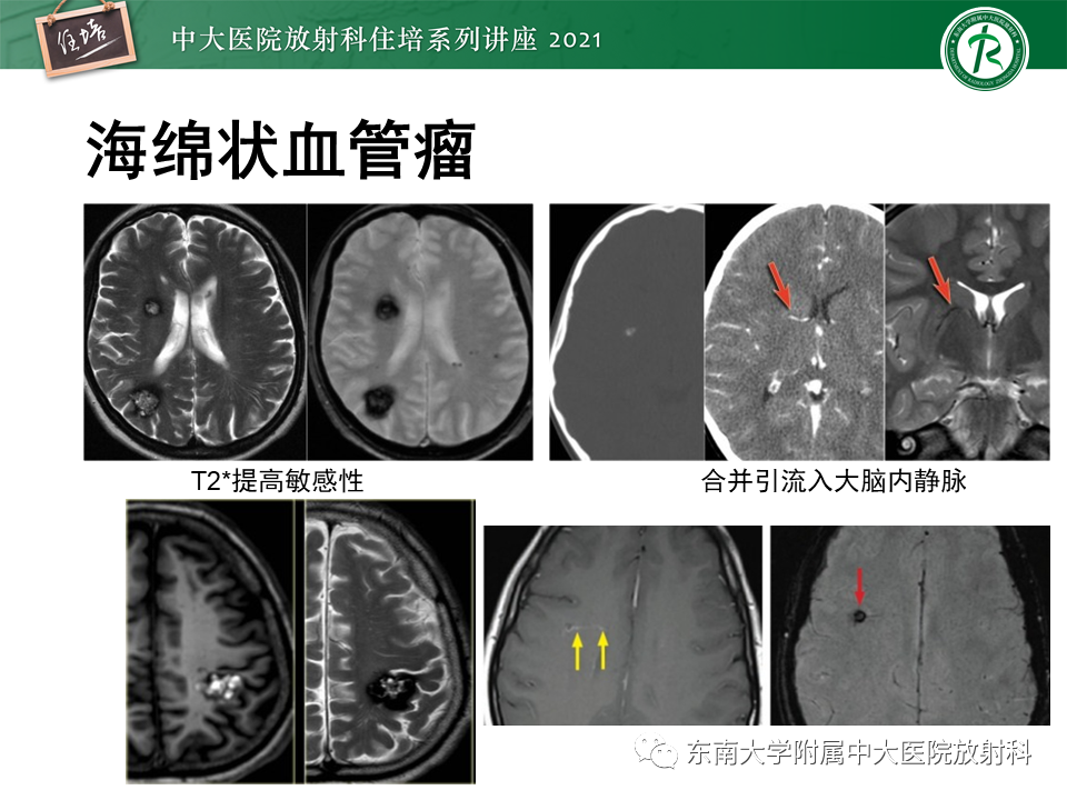 影像PPT - 【PPT】癫痫MR成像与常见疾病-47