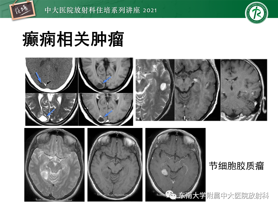 影像PPT - 【PPT】癫痫MR成像与常见疾病-50