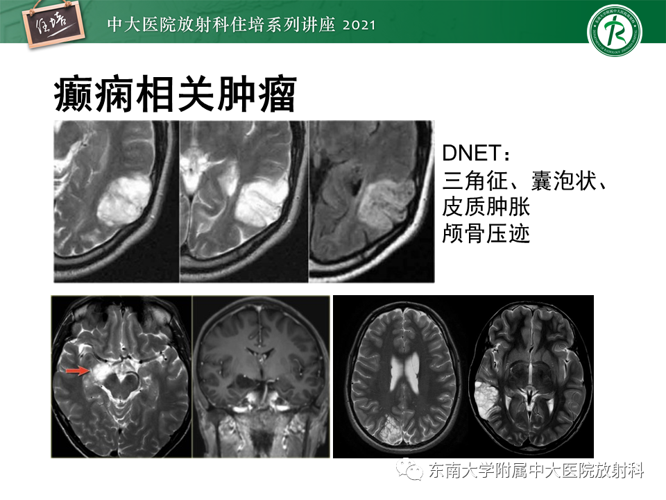 影像PPT - 【PPT】癫痫MR成像与常见疾病-51