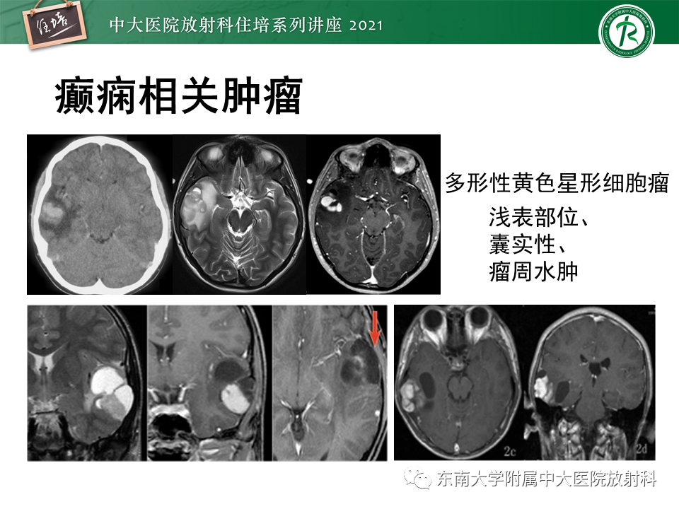 影像PPT - 【PPT】癫痫MR成像与常见疾病-52