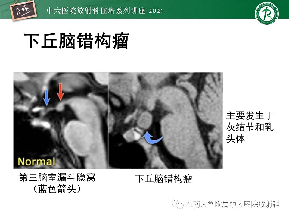 影像PPT - 【PPT】癫痫MR成像与常见疾病-53