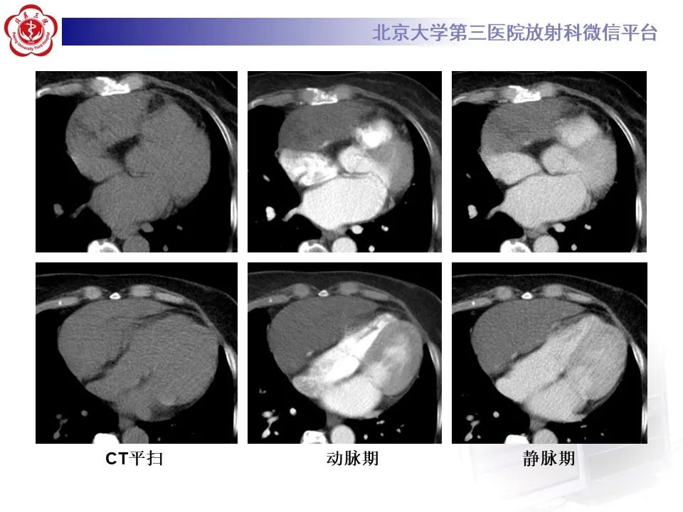 影像PPT - 【病例】心包内脉管畸形1例CT及MR影像-3