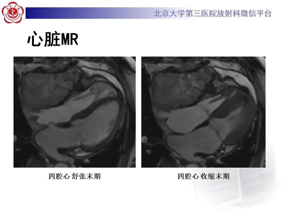 影像PPT - 【病例】心包内脉管畸形1例CT及MR影像-5