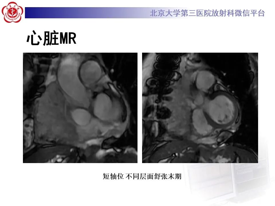 影像PPT - 【病例】心包内脉管畸形1例CT及MR影像-6