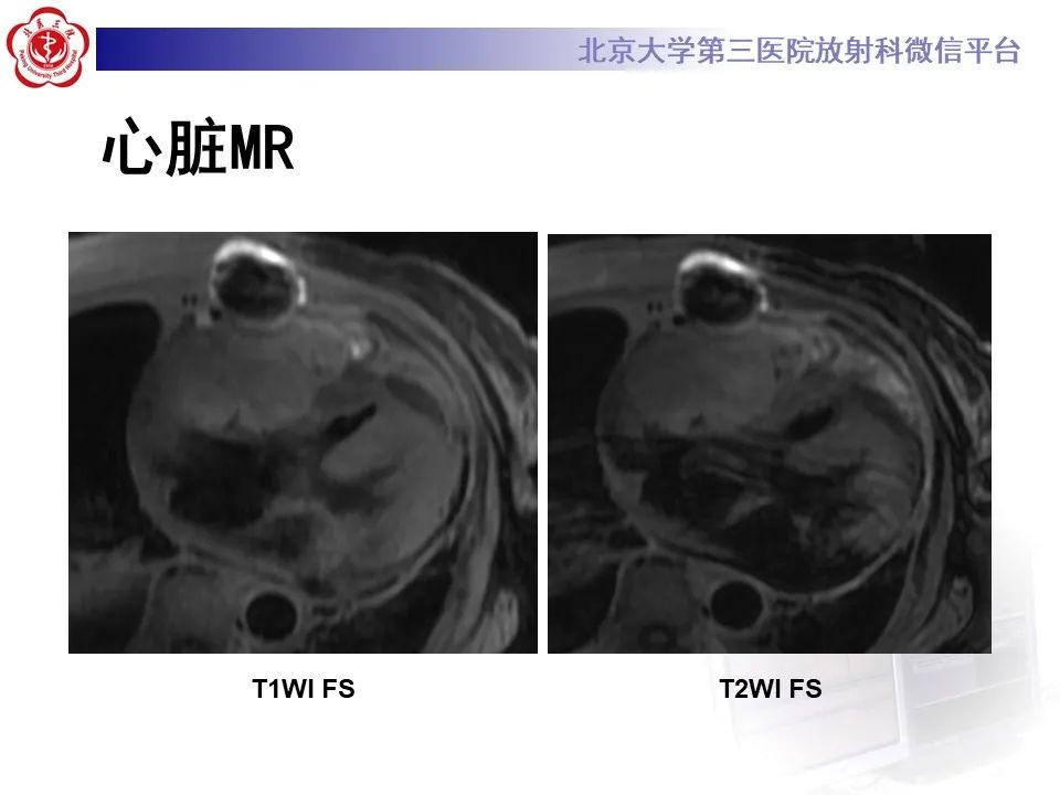 影像PPT - 【病例】心包内脉管畸形1例CT及MR影像-7