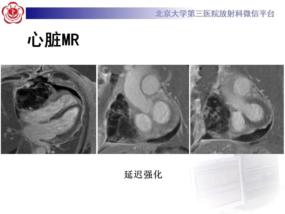 影像PPT - 【病例】心包内脉管畸形1例CT及MR影像-8