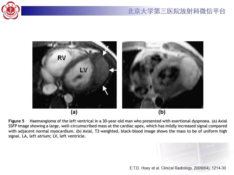 影像PPT - 【病例】心包内脉管畸形1例CT及MR影像-23