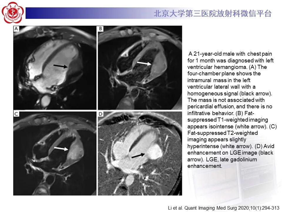 影像PPT - 【病例】心包内脉管畸形1例CT及MR影像-24