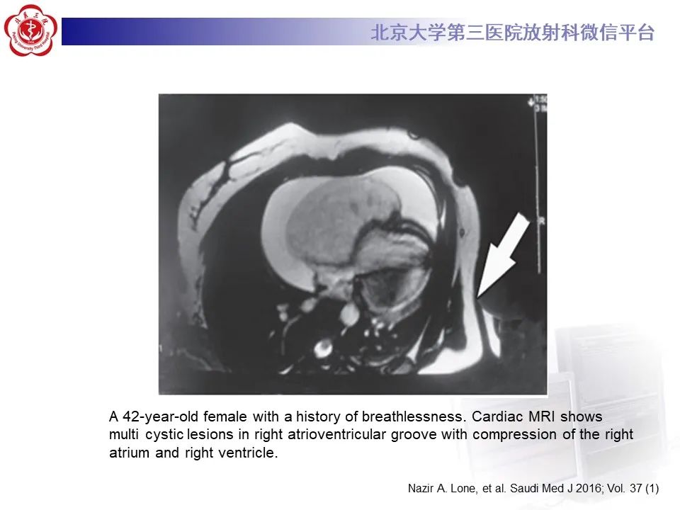 影像PPT - 【病例】心包内脉管畸形1例CT及MR影像-26
