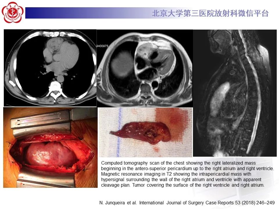 影像PPT - 【病例】心包内脉管畸形1例CT及MR影像-27