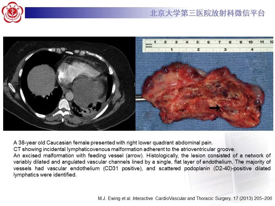 影像PPT - 【病例】心包内脉管畸形1例CT及MR影像-29