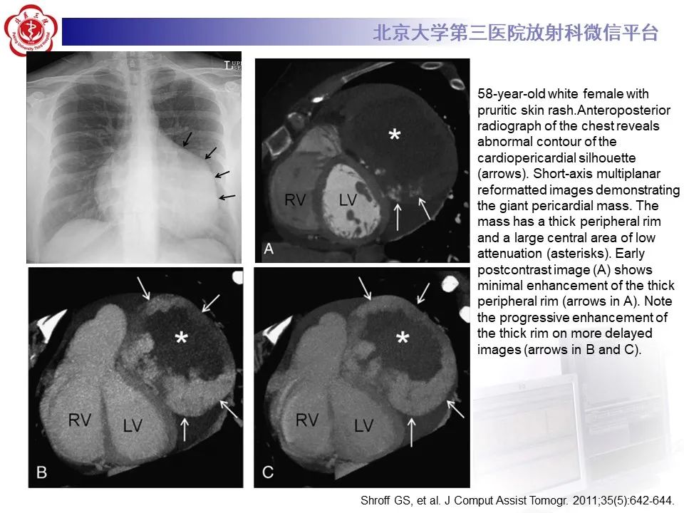 影像PPT - 【病例】心包内脉管畸形1例CT及MR影像-30