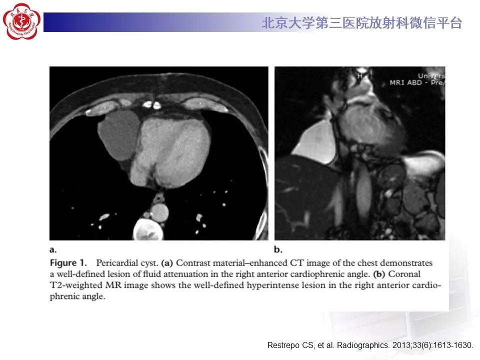 影像PPT - 【病例】心包内脉管畸形1例CT及MR影像-32