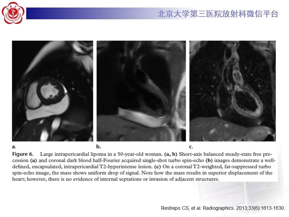 影像PPT - 【病例】心包内脉管畸形1例CT及MR影像-33