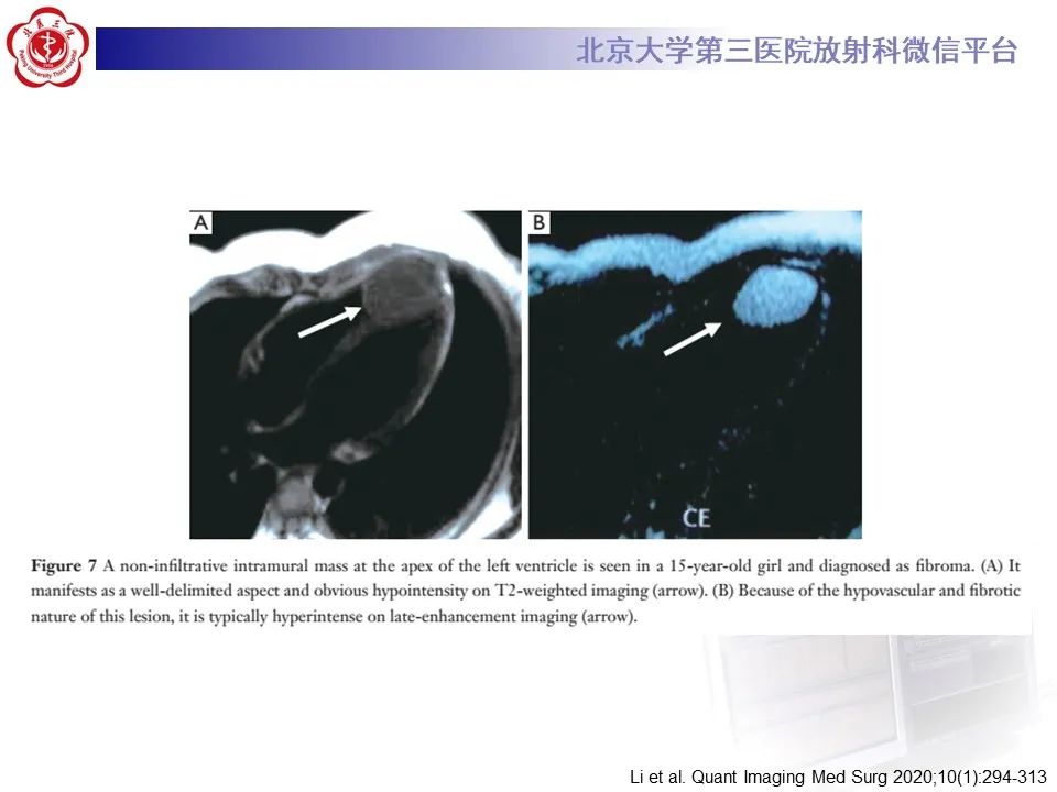 影像PPT - 【病例】心包内脉管畸形1例CT及MR影像-34