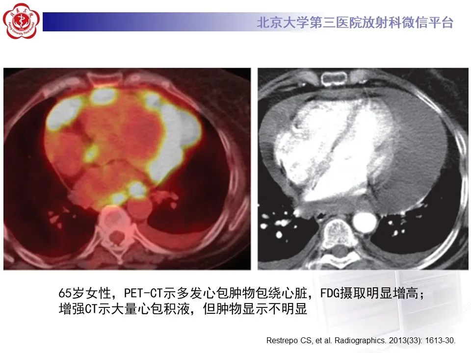 影像PPT - 【病例】心包内脉管畸形1例CT及MR影像-36