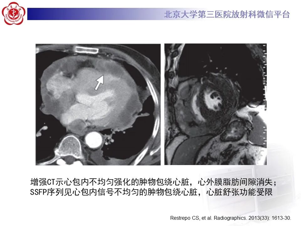影像PPT - 【病例】心包内脉管畸形1例CT及MR影像-37