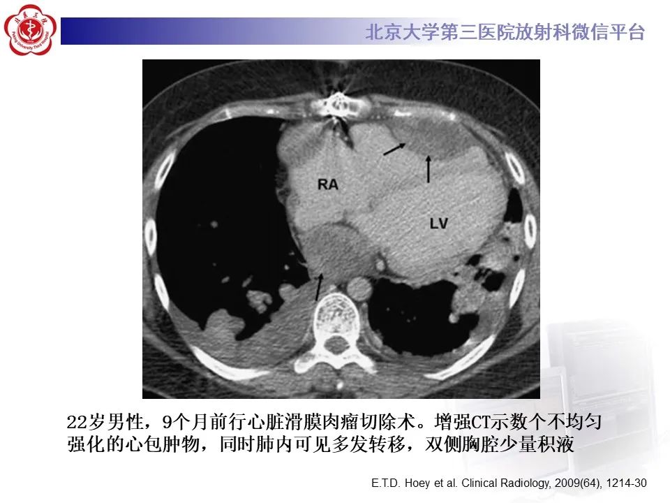 影像PPT - 【病例】心包内脉管畸形1例CT及MR影像-39