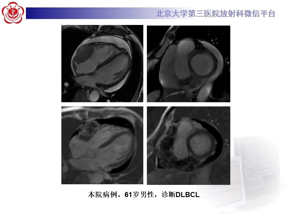 影像PPT - 【病例】心包内脉管畸形1例CT及MR影像-41