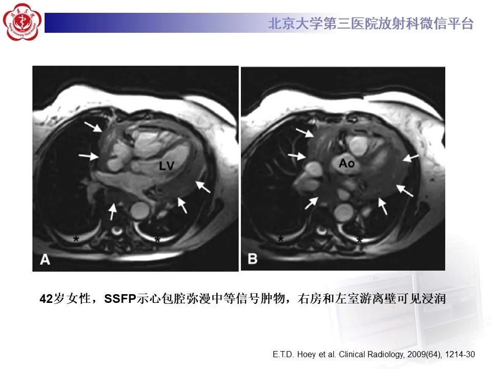 影像PPT - 【病例】心包内脉管畸形1例CT及MR影像-42