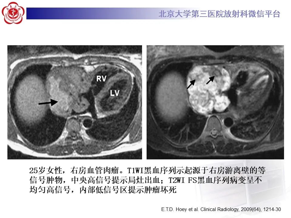 影像PPT - 【病例】心包内脉管畸形1例CT及MR影像-44