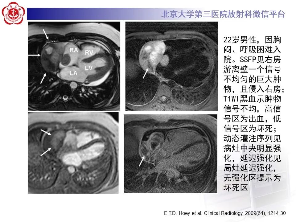 影像PPT - 【病例】心包内脉管畸形1例CT及MR影像-45