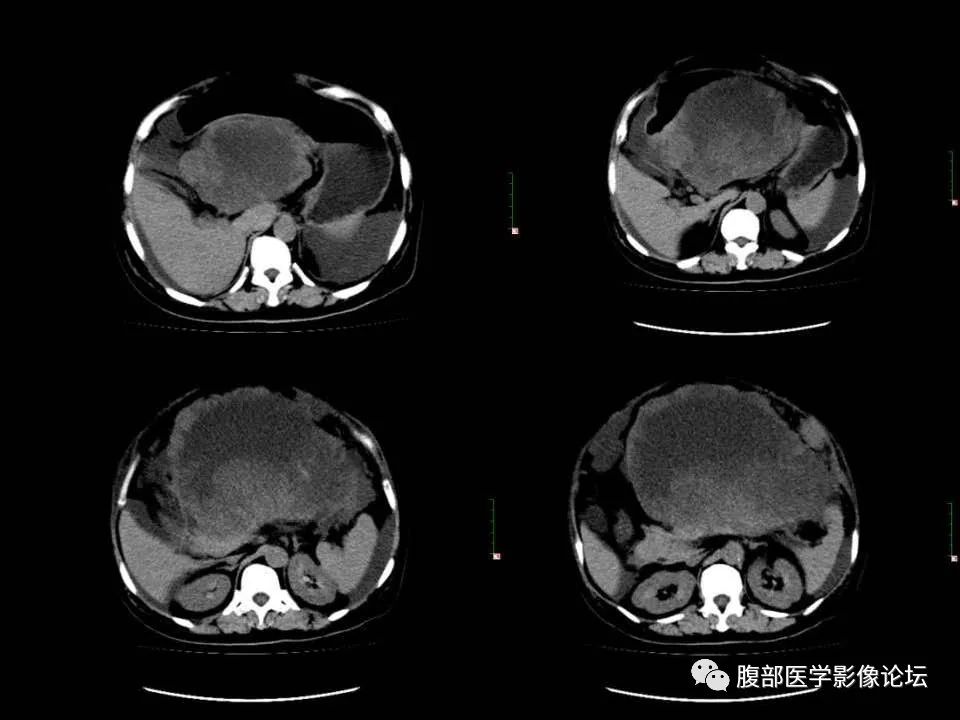 影像PPT - 【病例】胰腺平滑肌肉瘤1例CT影像诊断-6 影像PPT - 【病例】胰腺平滑肌肉瘤1例CT影像诊断-6
