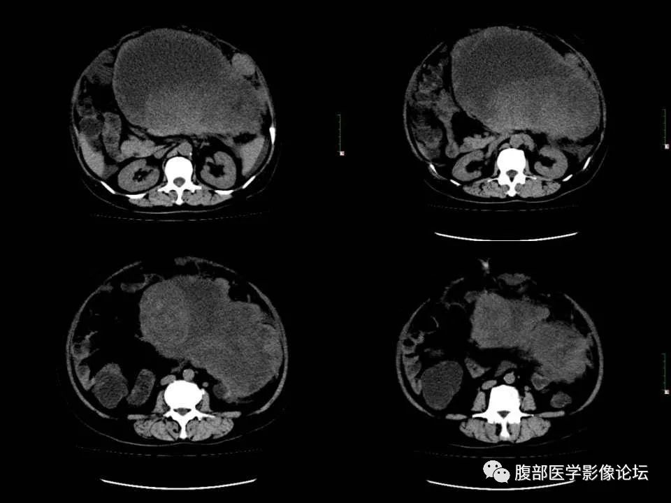 影像PPT - 【病例】胰腺平滑肌肉瘤1例CT影像诊断-7 影像PPT - 【病例】胰腺平滑肌肉瘤1例CT影像诊断-7
