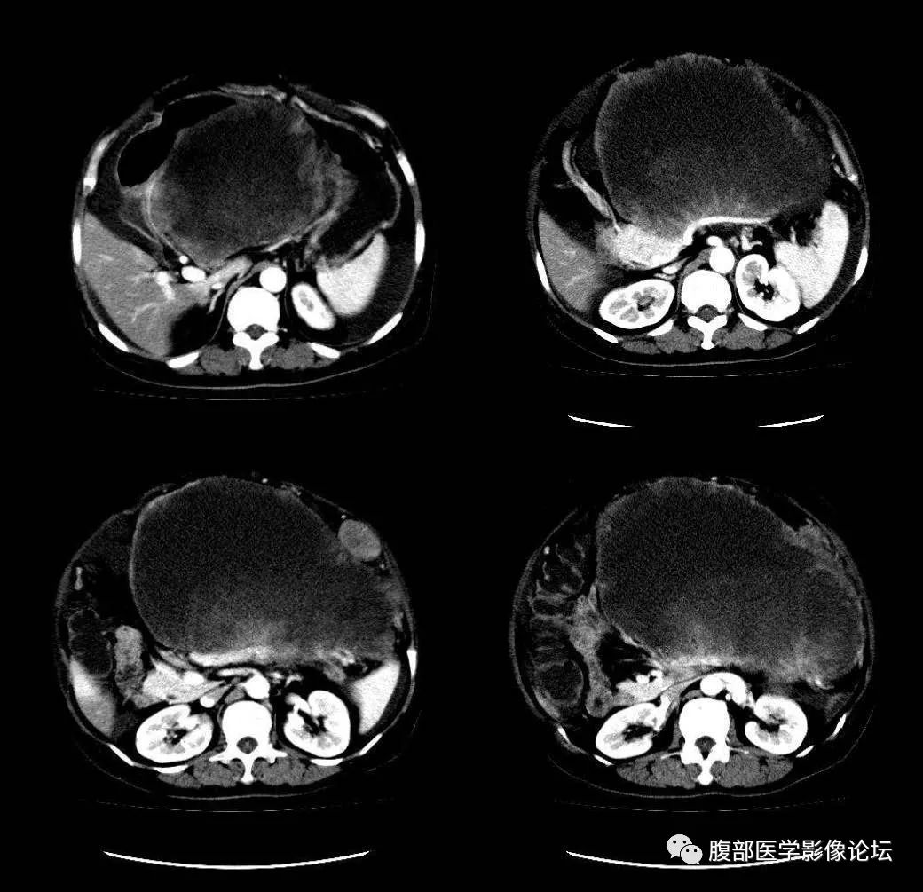 影像PPT - 【病例】胰腺平滑肌肉瘤1例CT影像诊断-9 影像PPT - 【病例】胰腺平滑肌肉瘤1例CT影像诊断-9
