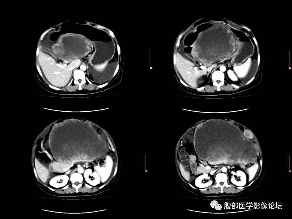影像PPT - 【病例】胰腺平滑肌肉瘤1例CT影像诊断-11 影像PPT - 【病例】胰腺平滑肌肉瘤1例CT影像诊断-11