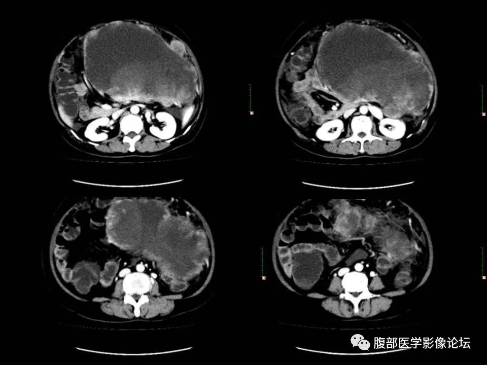 影像PPT - 【病例】胰腺平滑肌肉瘤1例CT影像诊断-12 影像PPT - 【病例】胰腺平滑肌肉瘤1例CT影像诊断-12