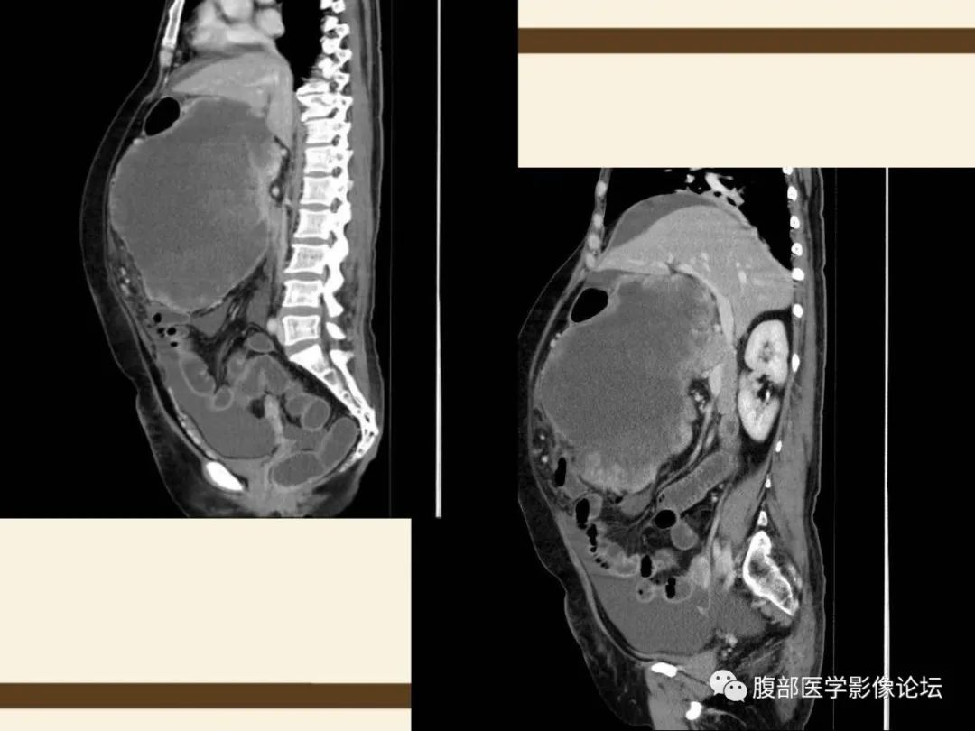 影像PPT - 【病例】胰腺平滑肌肉瘤1例CT影像诊断-17 影像PPT - 【病例】胰腺平滑肌肉瘤1例CT影像诊断-17
