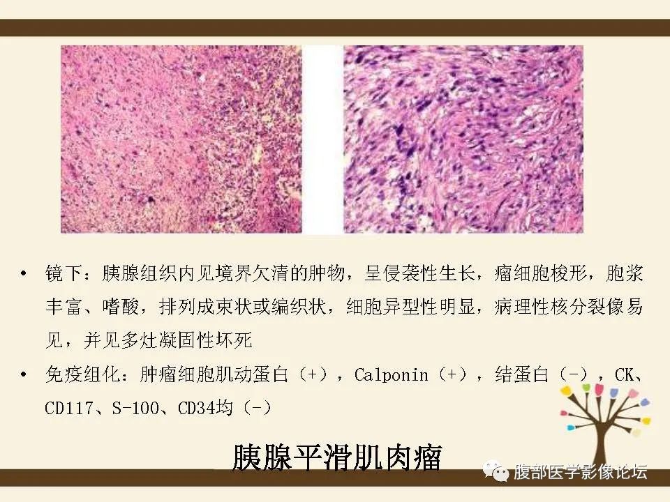 影像PPT - 【病例】胰腺平滑肌肉瘤1例CT影像诊断-19 影像PPT - 【病例】胰腺平滑肌肉瘤1例CT影像诊断-19