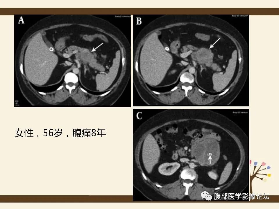 影像PPT - 【病例】胰腺平滑肌肉瘤1例CT影像诊断-25 影像PPT - 【病例】胰腺平滑肌肉瘤1例CT影像诊断-25