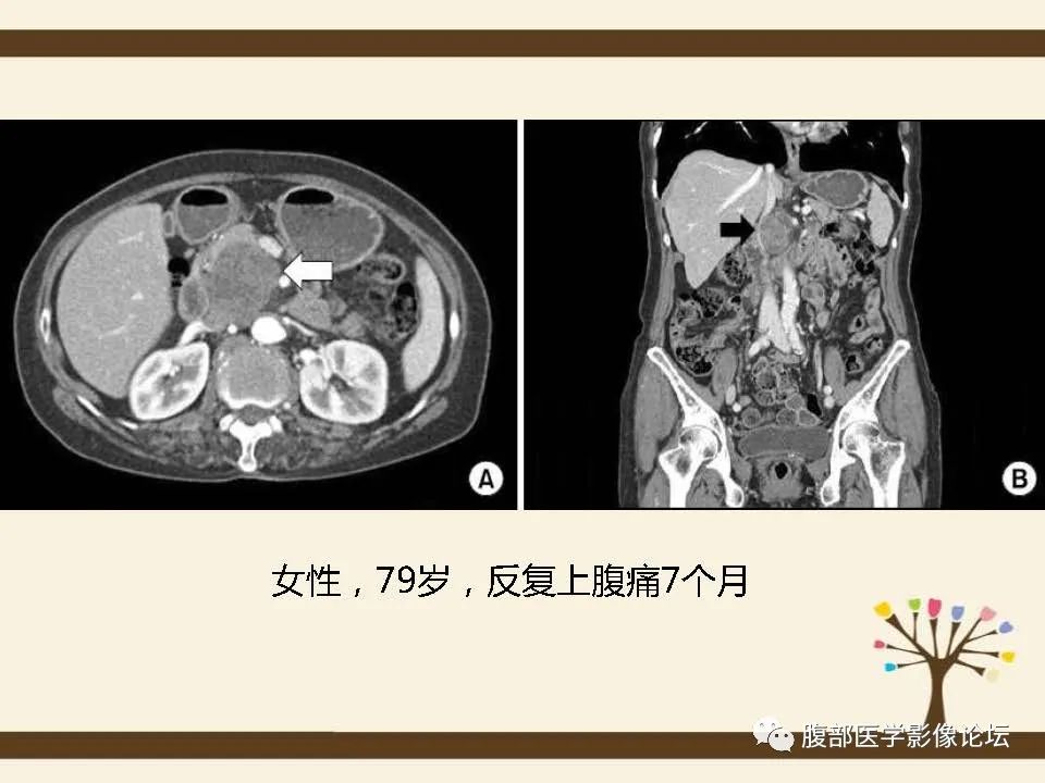 影像PPT - 【病例】胰腺平滑肌肉瘤1例CT影像诊断-26 影像PPT - 【病例】胰腺平滑肌肉瘤1例CT影像诊断-26