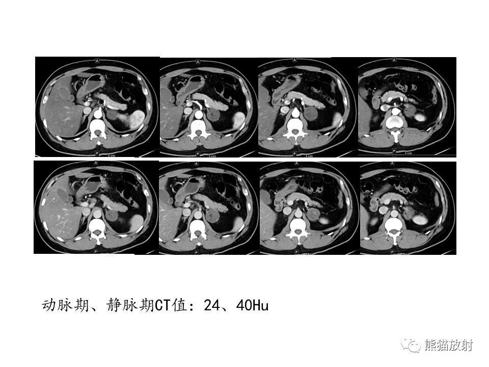 影像PPT - 【病例】肾上腺占位两例—腺瘤VS嗜铬细胞瘤CT及MR-5
