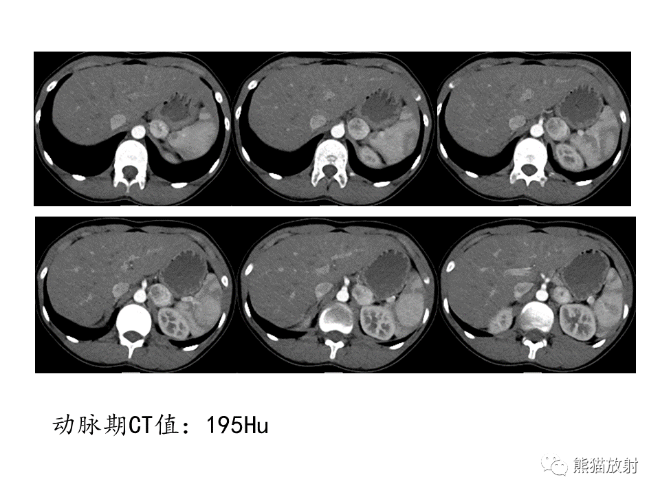 影像PPT - 【病例】肾上腺占位两例—腺瘤VS嗜铬细胞瘤CT及MR-13