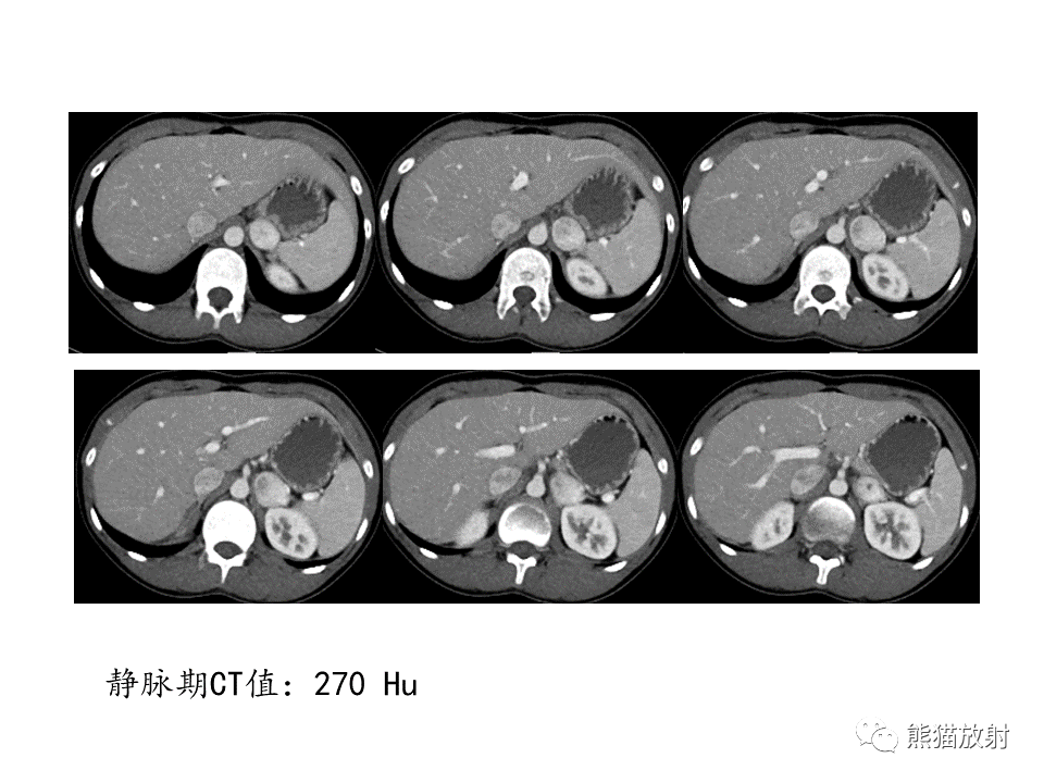 影像PPT - 【病例】肾上腺占位两例—腺瘤VS嗜铬细胞瘤CT及MR-14